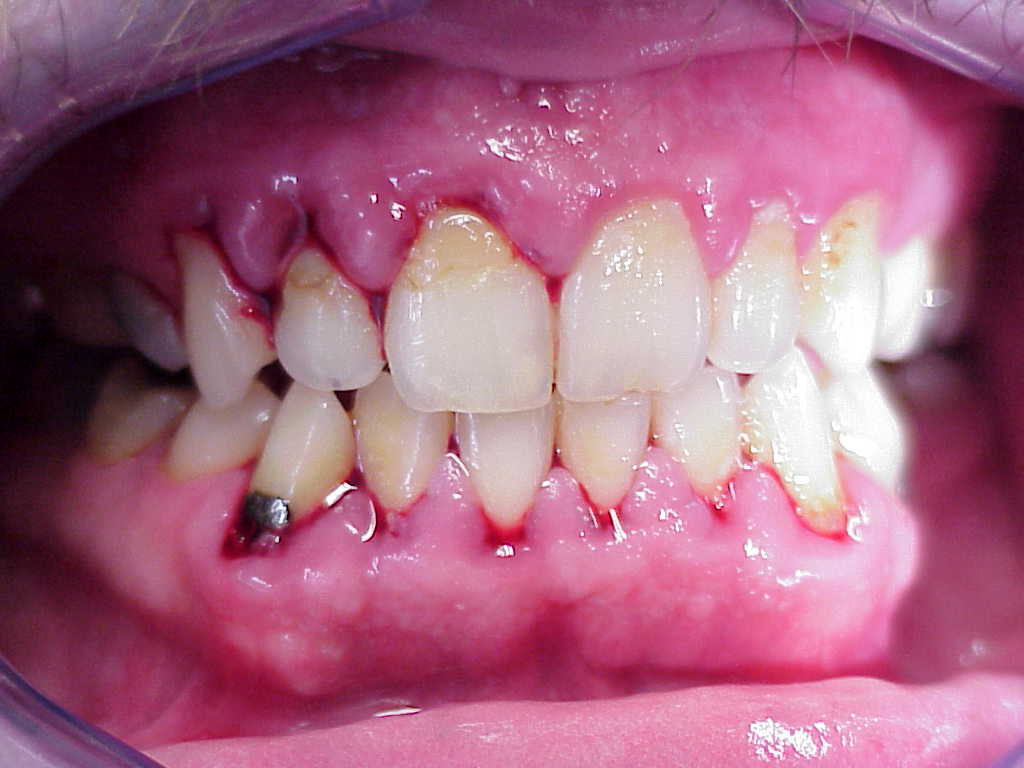 Bloedend tandvlees voor behandeling